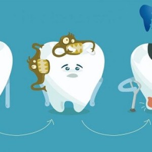 Sâu răng ở trẻ em: Nguyên nhân, dấu hiệu, tác hại và cách điều trị