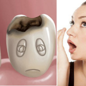 Sâu răng có gây hôi miệng không? Chữa thế nào DỨT ĐIỂM 100%