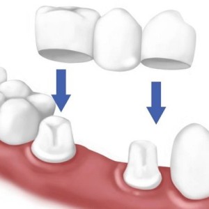 Phương pháp làm cầu răng sứ là gì? Ưu nhược điểm thế nào