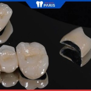 Nên bọc răng sứ titan không – Chuyên gia phân tích ưu nhược điểm chi tiết