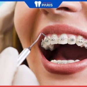 Mức chi phí niềng răng mắc cài kim loại bao nhiêu? Cách tính như nào? 