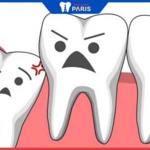 Dấu hiệu mọc răng khôn: Cách nhận biết và xử lý răng khôn đúng 
