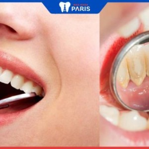 Lấy vôi răng: Tổng hợp các thông tin cần biết về lấy cao răng