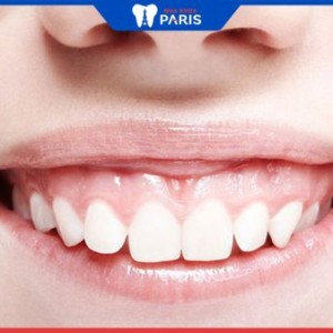 Răng ngắn cười hở lợi là gì? Cách chữa trị dứt điểm