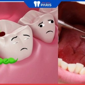 Sâu răng là gì? 4 cách điều trị răng sâu bị thủng lỗ phổ biến