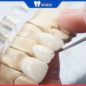 Bọc răng sứ toàn hàm giá bao nhiêu? Khi nào cần bọc răng cả hàm?