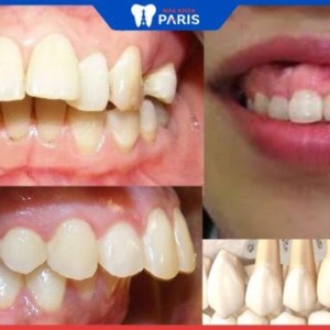 Cách nhận biết răng hô chuẩn xác và phương pháp điều trị triệt để
