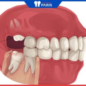 Có nên nhổ 2 răng khôn cùng lúc và có bị ảnh hưởng gì không?