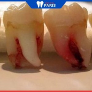 Nhổ 4 răng khôn cùng lúc được không? 5 lưu ý khi nhổ răng khôn