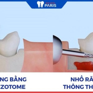 Nhổ răng siêu âm piezotome và 4 điều cần biết 