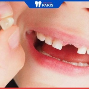 Nhổ răng sữa cho trẻ ở đâu an toàn, không gây biến chứng?