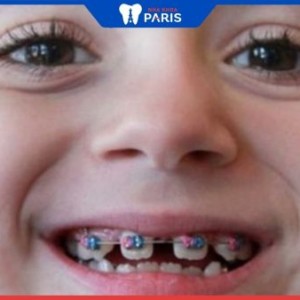 Lưu ý khi niềng răng cho trẻ 6 tuổi tại Nha khoa Paris 