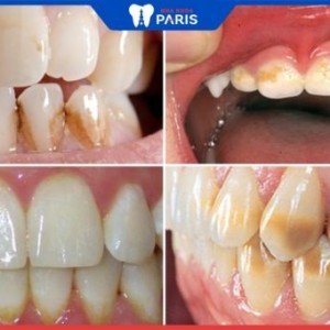 Răng bị ố vàng, 10+ nguyên nhân và 3 phương pháp chữa trị