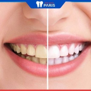 Răng ố vàng nguyên nhân là gì? 7 cách xử lý hiệu quả nhất