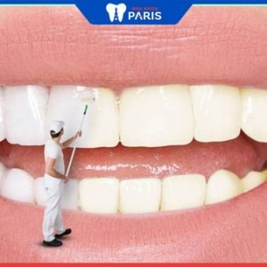 Tổng hợp 5 câu hỏi thường gặp về tẩy trắng răng