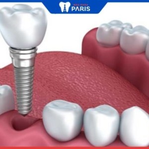 Thời gian làm răng implant bao lâu? 3 cách rút ngắn thời gian hiệu quả