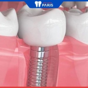 Trồng răng giả tại Đà Nẵng – Nha khoa Paris – Bảng giá mới 2022