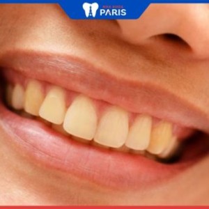Răng bị ố vàng khi mang thai? Cách ngăn ngừa răng bị vàng