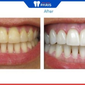 Có nên tẩy trắng răng không – 3 cách “bật tone” răng nhanh chóng
