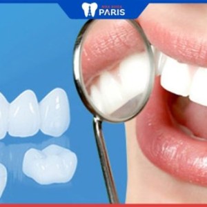 Răng bọc sứ : Chi phí, tuổi thọ răng sứ- 14 điều cần biết về răng sứ