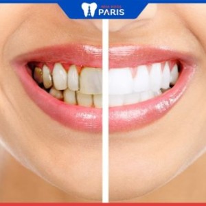 Tẩy trắng răng có đau không? những lưu ý kèm theo