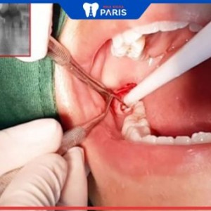 Nhổ răng khôn số 8 có ảnh hưởng gì đến hàm không?