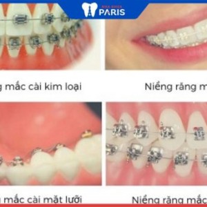Top các kiểu niềng răng chất lượng phổ biến  tại Paris