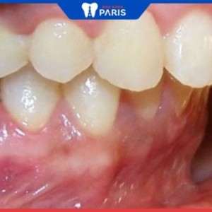 Các kiểu răng hô vẩu: Phân loại răng và cách điều trị hô vẫu