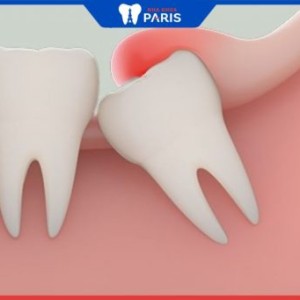 9 cách giảm đau khi mọc răng khôn – TS Đàm Ngọc Trâm chia sẻ