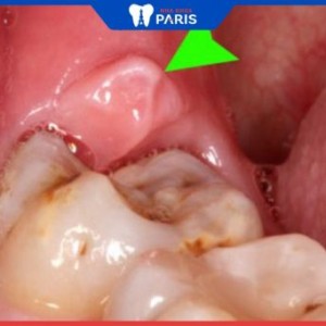 6 dấu hiệu mọc răng khôn hàm dưới – Tiến sĩ Đàm Ngọc Trâm cho biết