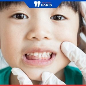 Cha mẹ nên niềng răng cho trẻ khi nào là hợp lý nhất?