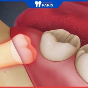 Nguyên nhân mọc răng khôn là gì? 10 dấu hiệu nhận biết răng sắp mọc