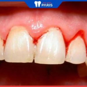 5 cách trị viêm nướu răng chảy máu hiệu quả ít tốn kém