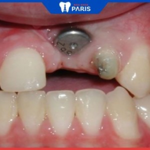 Cấy trụ implant – Công nghệ phục hồi răng mất giống 100% răng thật