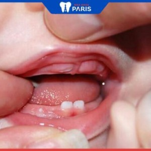 Giai đoạn mọc răng của trẻ và lịch mọc răng đầy đủ của trẻ