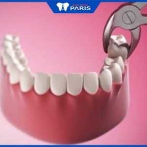 Nhổ răng số 7 hàm dưới có đau không? Bao lâu thì trồng được răng mới?