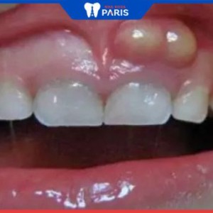 Cách điều trị viêm nướu răng có mủ an toàn, đơn giản