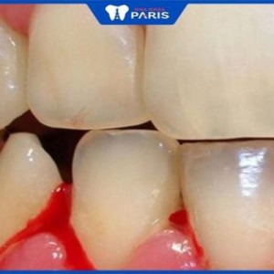 5 Nguyên nhân chảy máu nướu răng thường xuyên