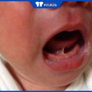 Dính phanh lưỡi ảnh hưởng tới trẻ thế nào? Biện pháp điều trị?