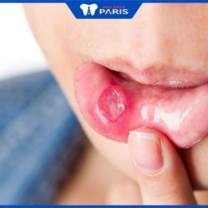 Nhiệt miệng có gây sốt không – Giải đáp từ bác sĩ Nha khoa Paris