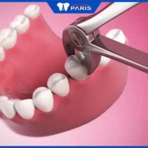 Nhổ răng hàm có nguy hiểm không – 3 Lưu ý chọn địa chỉ nhổ răng