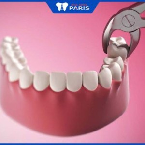 Nhổ răng khôn sưng bao lâu – 5 Cách giảm sưng nhanh chóng