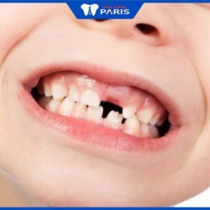 Nhổ răng sữa bao lâu mọc lại? 5 Nguyên nhân khiến răng mọc chậm
