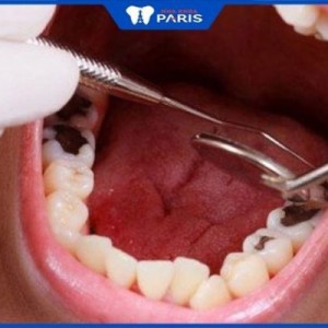 Răng khôn bị sâu có những tác hại nào? Nên nhổ bỏ hay không?
