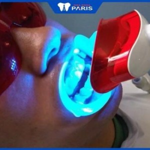 Giải đáp thắc mắc: Tẩy trắng răng có an toàn không?