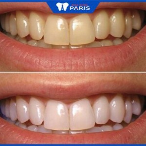 Tẩy trắng răng có bị ê buốt không? 4 Cách giảm ê buốt