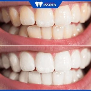 Tẩy trắng răng có đau không – Giải đáp từ bác sĩ Nha khoa Paris