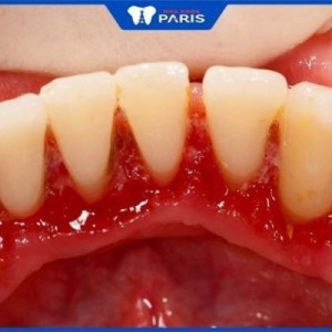 Viêm chân răng phải làm sao? – 3 giải pháp chữa trị hiệu quả