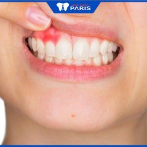 Viêm lợi chảy máu chân răng: Biểu hiện, cách điều trị hiệu quả