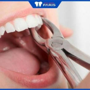 Nhổ răng có ảnh hưởng gì không – 3 trường hợp cần nhổ răng
